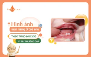 Hình ảnh sún răng ở trẻ em theo từng mức độ và vị trí thường gặp