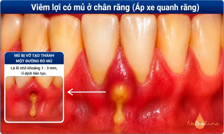 Áp xe quanh nha chu xuất hiện đường rò mủ.