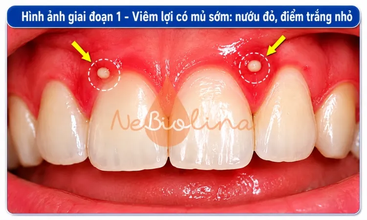 Viêm lợi có mủ sớm với những điểm trắng nhỏ.