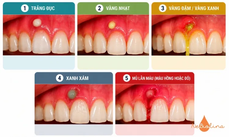Màu sắc của mủ phản ánh tình trạng khác nhau.