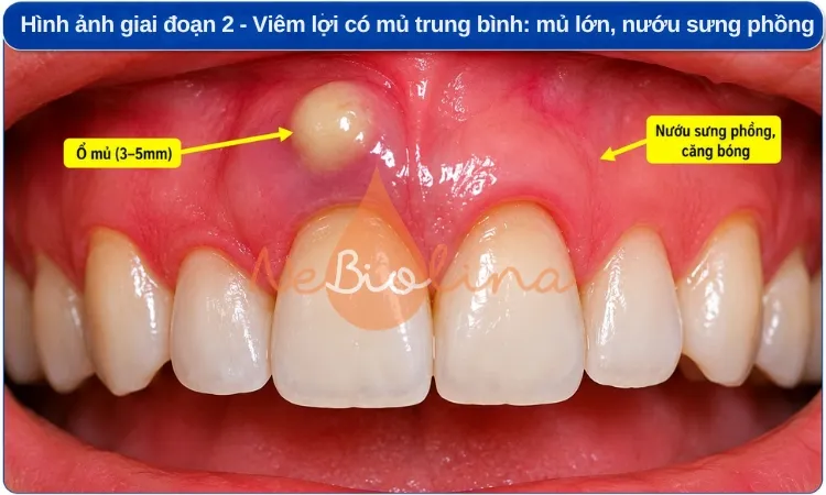 Ổ mủ phát triển lớn hơn.