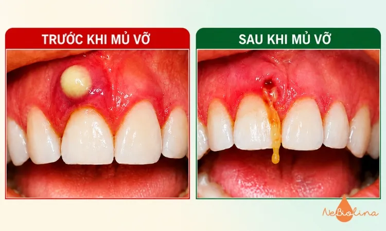 Dịch mủ được dẫn lưu ra ngoài nhưng tình trạng nhiễm trùng bên dưới vẫn còn.
