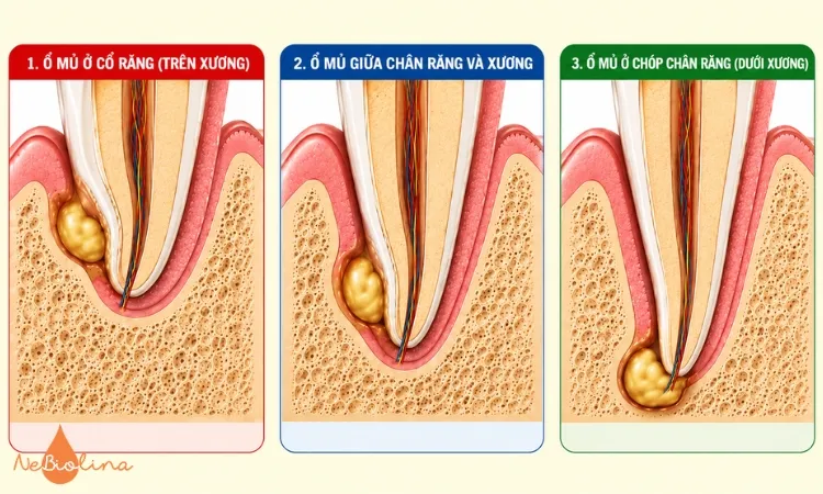 Ổ mủ có thể xuất hiện ở nhiều vị trí khác nhau.
