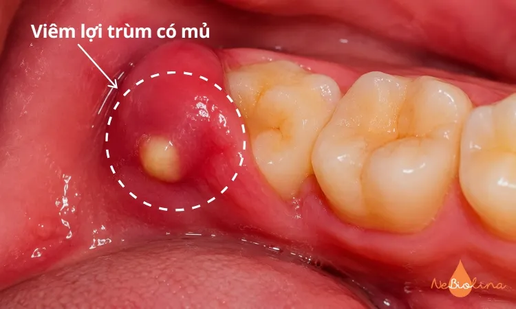 Viêm lợi trùm có mủ quanh răng khôn.