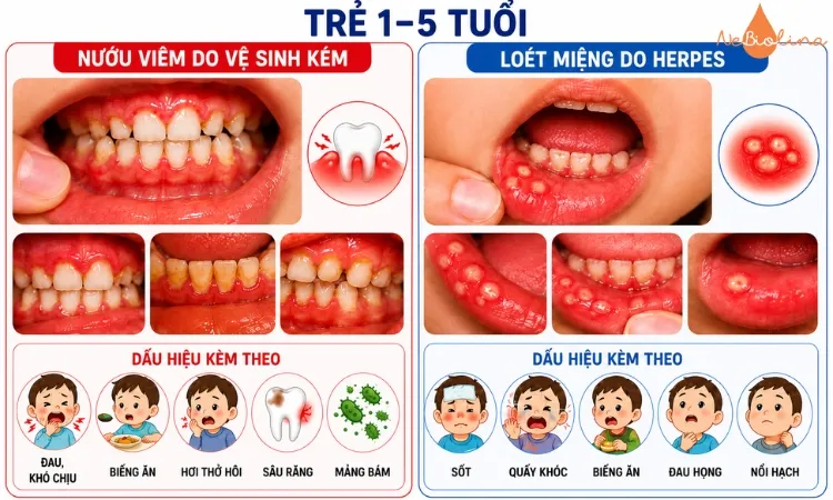Trẻ 1 - 5 tuổi dễ bị viêm lợi hoặc nhiễm virus Herpes.