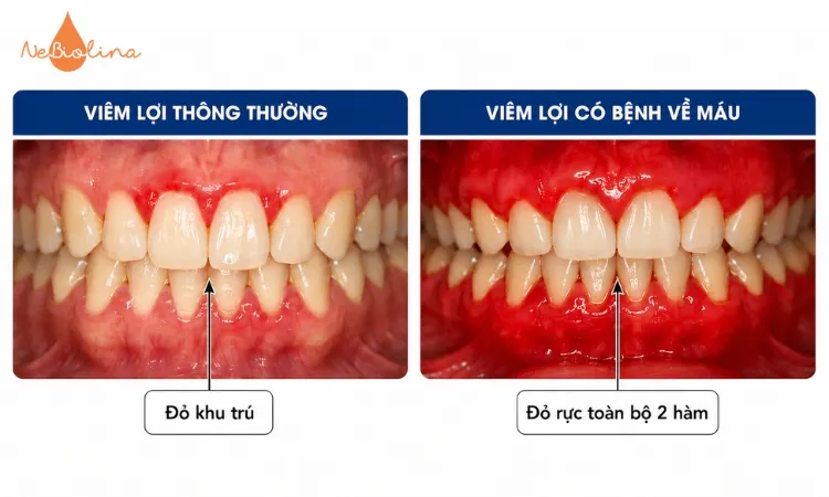 Viêm lợi khi có bệnh về máu khác so với viêm lợi thông thường.