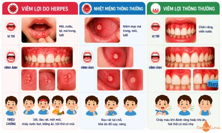 Viêm lợi do Herpes có nhiều điểm khác biệt so với viêm lợi và nhiệt miệng thông thường.
