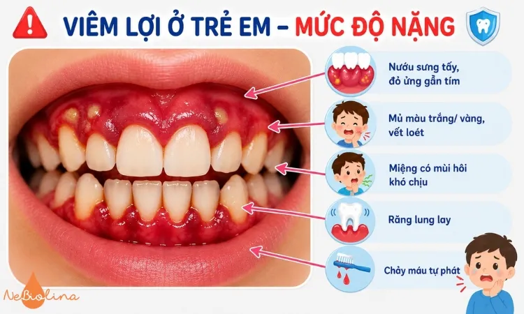 Hình ảnh viêm lợi nặng ở trẻ em.