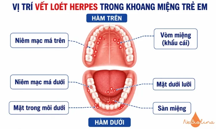Vết loét Herpes phân bố khắp khoang miệng.