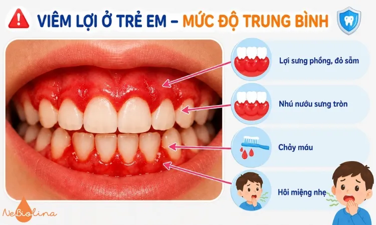 Hình ảnh viêm lợi trung bình ở trẻ em.