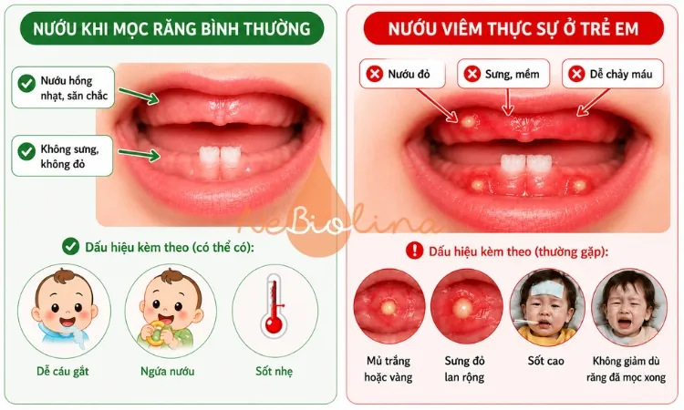 Viêm lợi khi mọc răng là tình trạng phổ biến.
