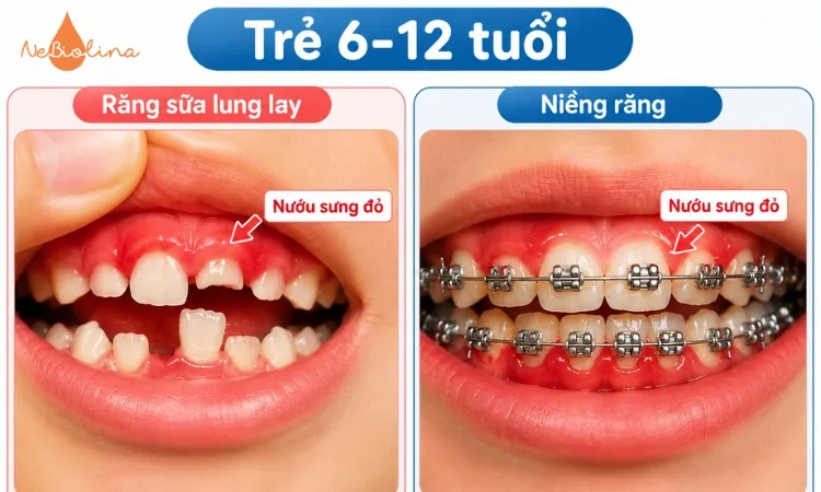 Trẻ 6 - 12 tuổi bị viêm lợi do thay răng hoặc niềng răng.