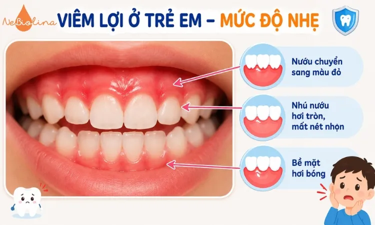 Hình ảnh viêm lợi nhẹ ở trẻ em.
