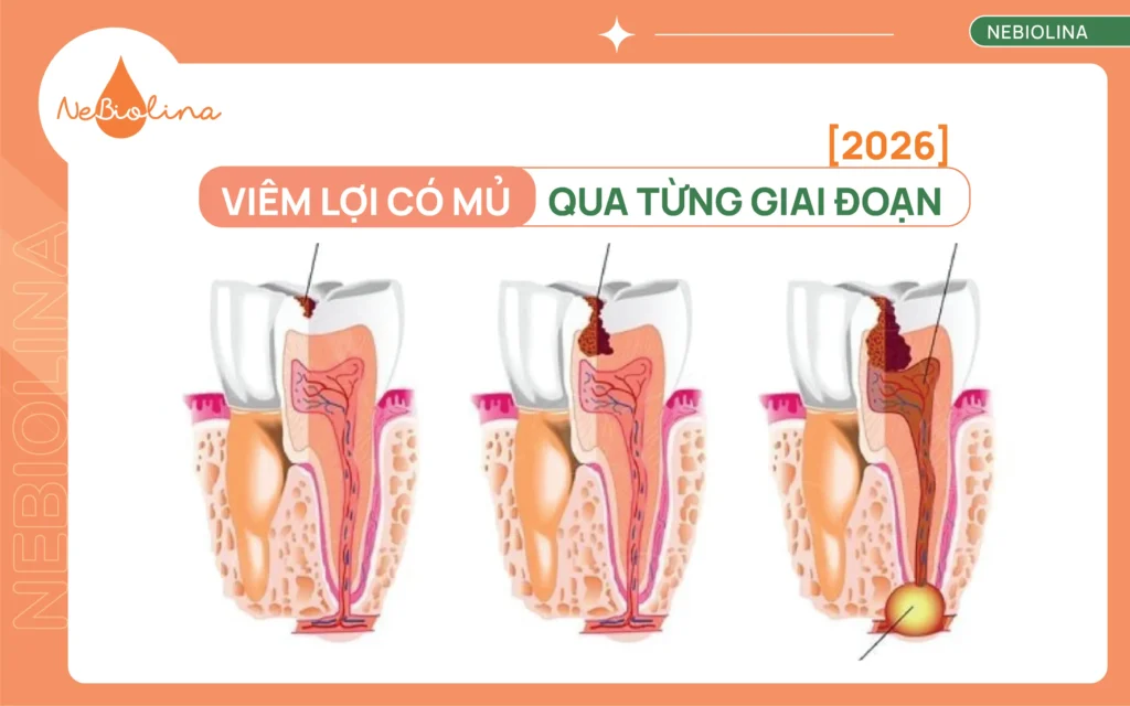 Hình ảnh viêm lợi có mủ qua từng giai đoạn