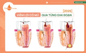 Hình ảnh viêm lợi có mủ qua từng giai đoạn