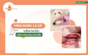 Viêm nướu là gì