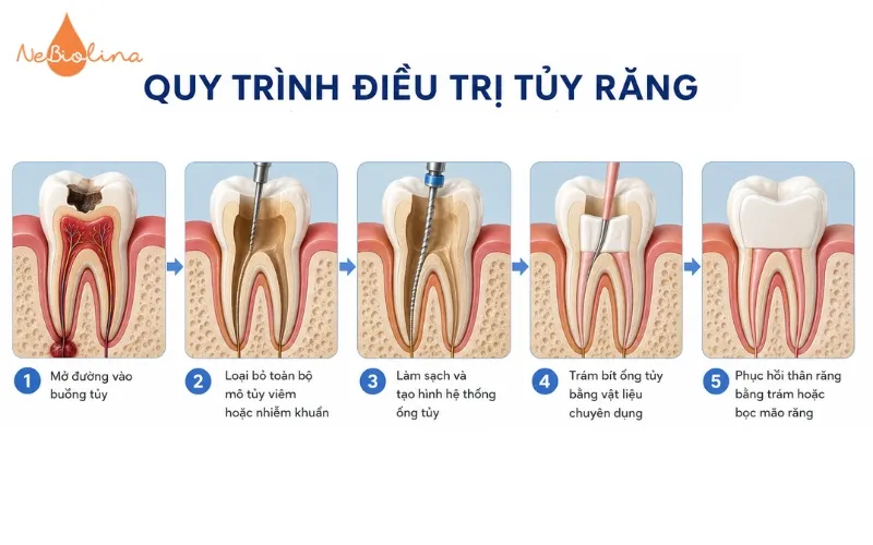 Quá trình điều trị viêm tủy răng hàm