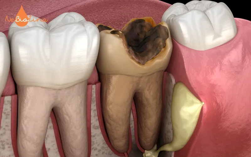 Răng hàm có nhiều hố rãnh dễ tích tụ vi khuẩn