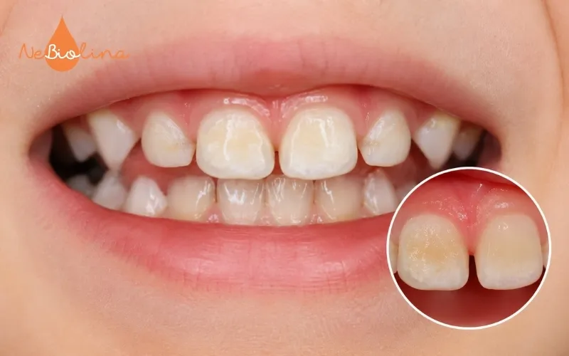Sún răng nhẹ xuất hiện đốm trăng