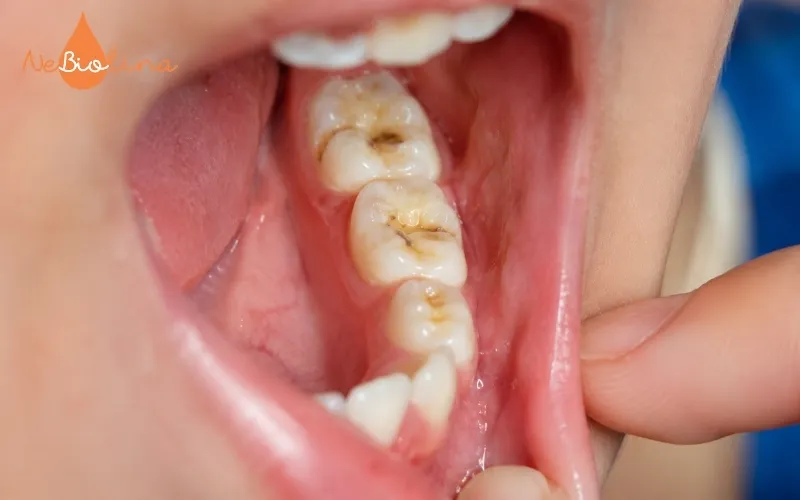 Sún răng hàm thường khó phát hiện