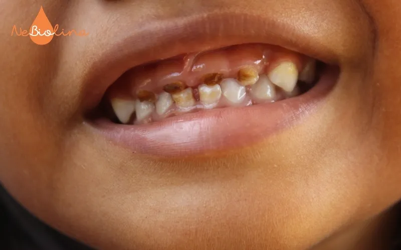 Trẻ bị sún nhiều răng do không được chữa trị kịp thời
