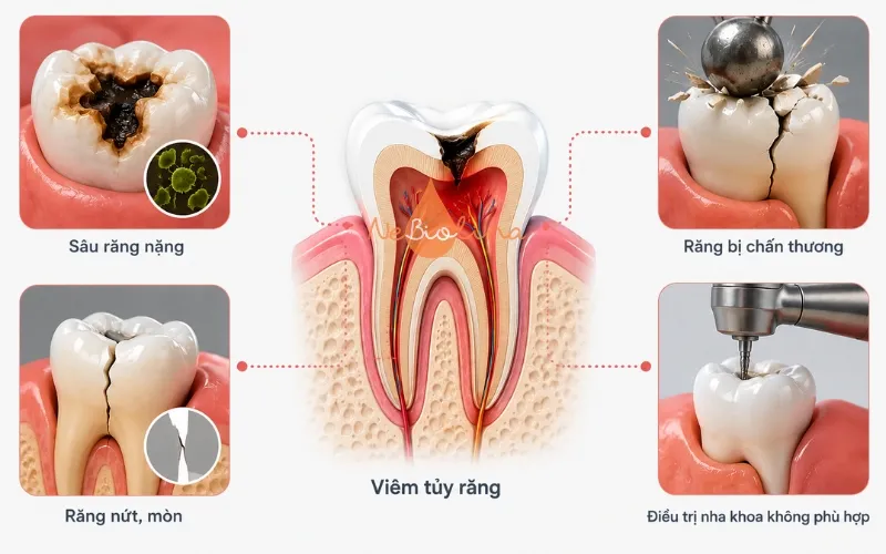 Nguyên nhân gây viêm tủy răng