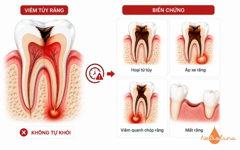 Bị viêm tủy răng nên làm gì-Biến chứng của viêm tủy răng nếu không được chữa trị kịp thời