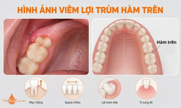 Viêm lợi trùm hàm trên thường nhẹ do răng khôn mọc thẳng hơn.