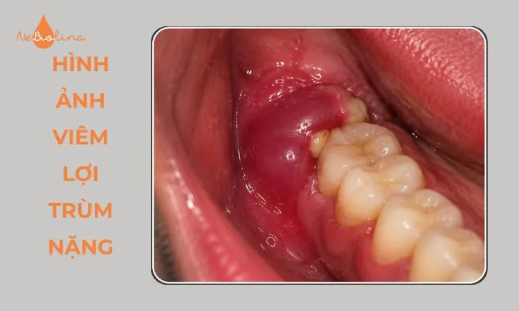 Viêm lợi trùm nặng có mủ, nướu đỏ tím và sưng lan rộng.