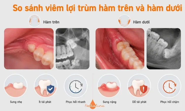 So sánh đặc điểm viêm lợi trùm ở hàm trên và hàm dưới.