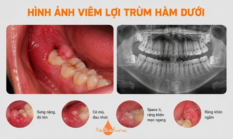 Viêm lợi trùm hàm dưới thường sưng đau và tái phát nhiều hơn.