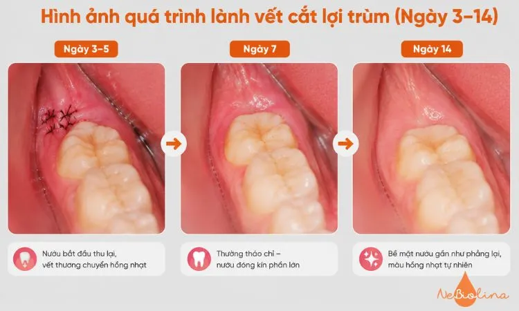 Nướu hồi phục dần từ ngày 3 đến ngày 14 sau cắt lợi trùm.
