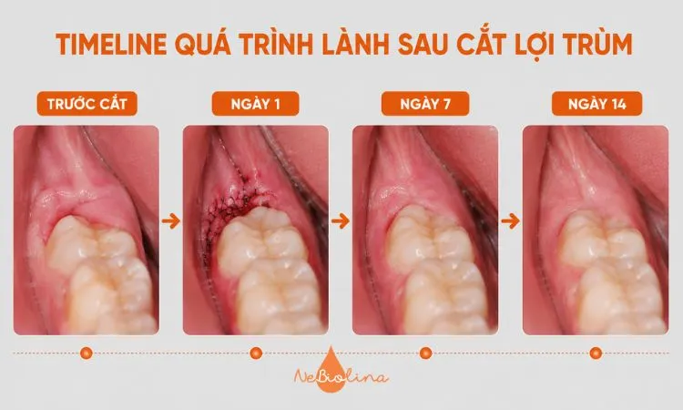 Quá trình lành thương từ trước cắt đến ngày 14 sau điều trị.