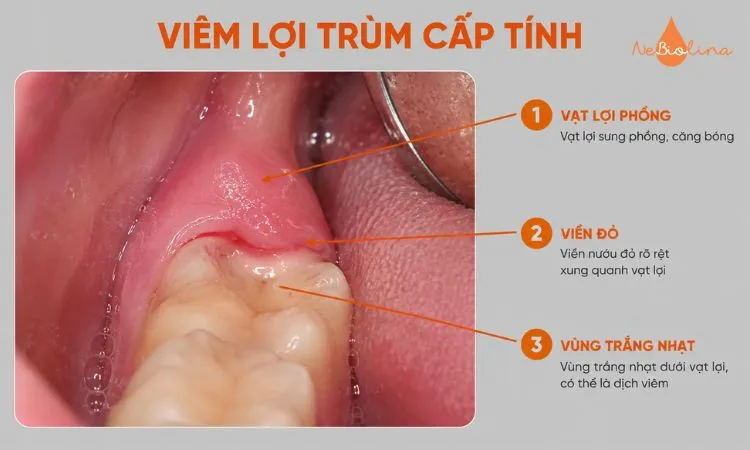 Vạt lợi sưng đỏ, phồng và xuất hiện dịch trắng dưới lợi.