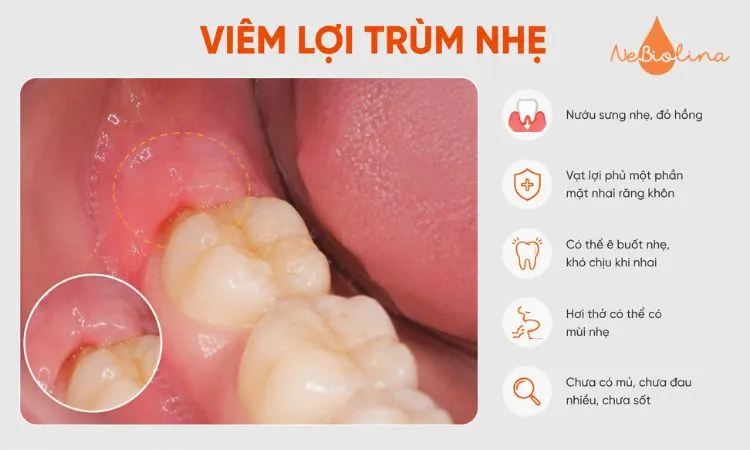 Hình ảnh lợi trùm nhẹ với vạt lợi phủ một phần răng khôn.