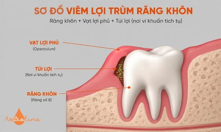 Sơ đồ mô tả vạt lợi phủ răng khôn và túi lợi tích tụ vi khuẩn.