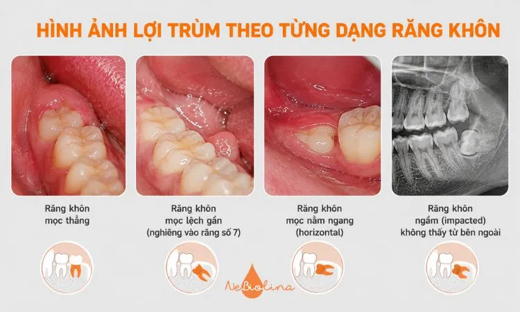 Hình ảnh lợi trùm theo từng dạng răng khôn