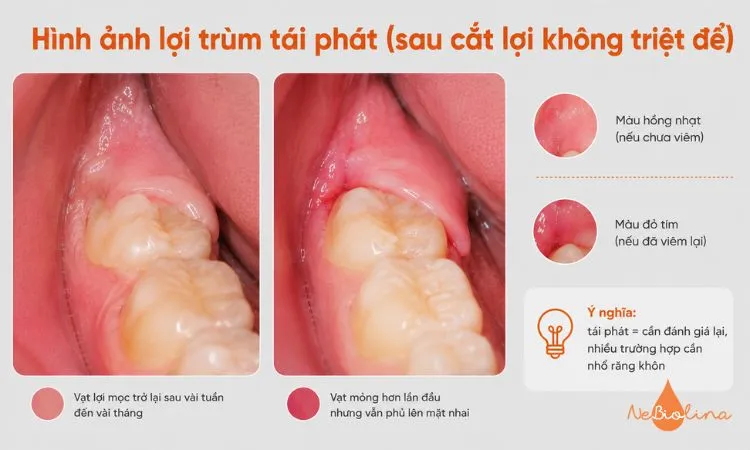 Vạt lợi mọc trở lại sau cắt lợi trùm không triệt để.