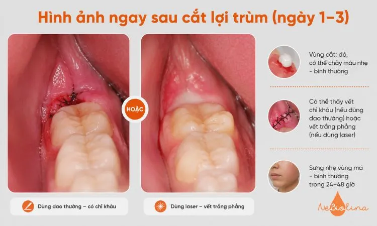 Vết cắt đỏ nhẹ, có thể chảy máu và sưng trong 24-48 giờ.