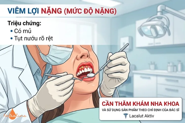 Viêm lợi mức độ nặng