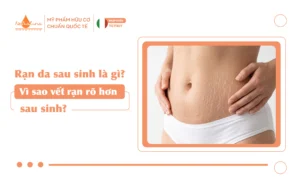 Rạn da sau sinh là gì_13