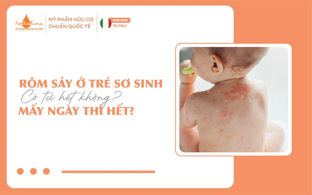 Rôm sảy ở trẻ sơ sinh có tự hết không Mấy ngày thì hết_15