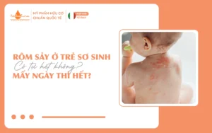 Rôm sảy ở trẻ sơ sinh có tự hết không Mấy ngày thì hết_15