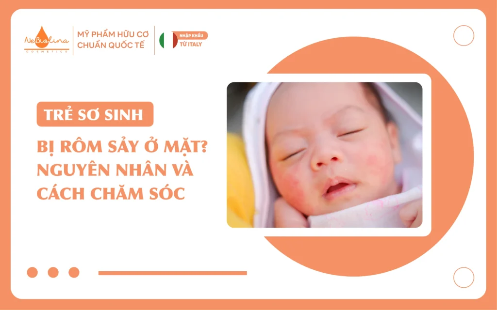 Trẻ sơ sinh bị rôm sảy ở mặt Nguyên nhân và cách chăm sóc_16
