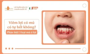 Viêm lợi có mủ có tự hết không