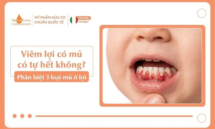 Viêm lợi có mủ có tự hết không