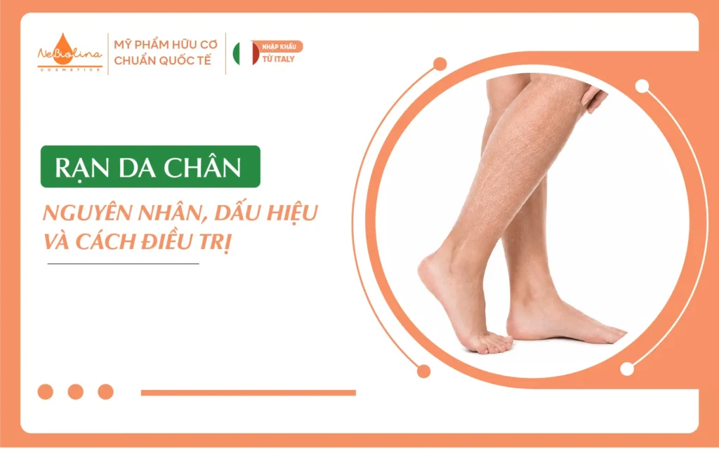 rạn da chân