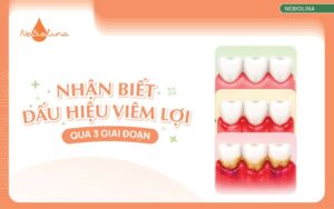 dấu hiệu viêm lợi