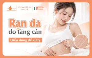 Rạn da do tăng cân Hiểu đúng để xử lý