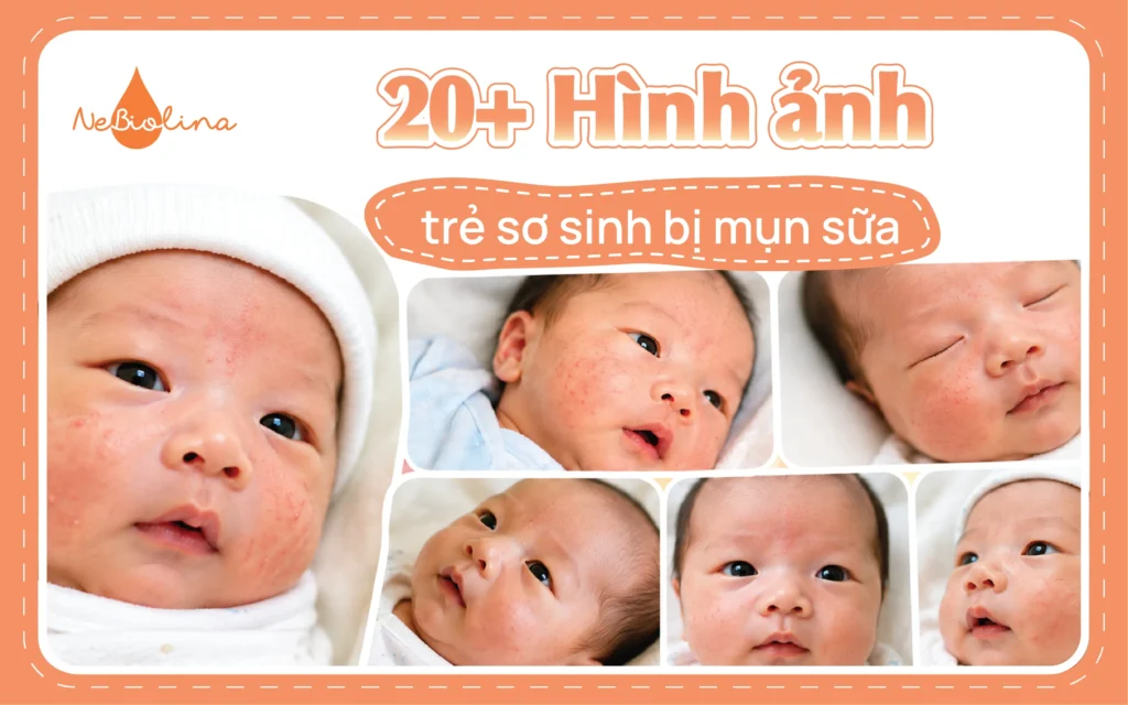 20 + hình ảnh trẻ sơ sinh bị mụn sữa